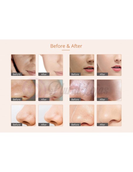 MICRODERMOABRASÃO + PEELING+ JATO DE OXIGENIO MAQUINAS MICRODERMOABRASÃO