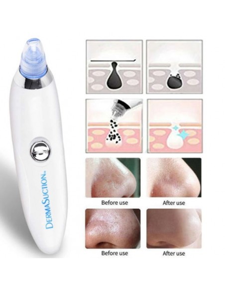 DERMASUCTION REMOVEDOR DE POROS - PORTUGAL TRATAMENTOS DE ROSTO