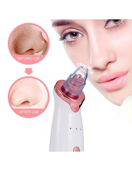 REMOVEDOR PONTOS NEGROS MICRODERMOABRASÃO MAQUINAS MICRODERMOABRASÃO